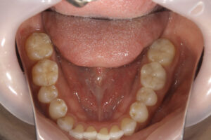 Ceramic inlay, ceramic onlay,