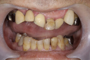 Underbite, crumbling teeth,