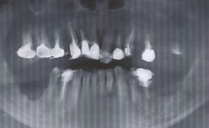 ひどい受け口ですが治せますか?