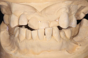crumbling teeth, orthodontics
