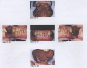 ひどい受け口ですが治せますか?