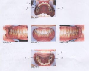 高齢になっても健康な歯で痛い４０代女性