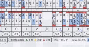 食事中に歯が抜けた５９歳女性