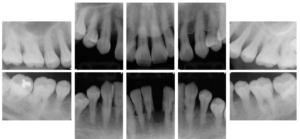食事中に歯が抜けた５９歳女性