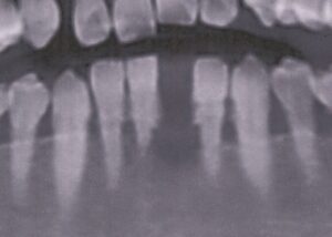 食事中に歯が抜けた５９歳女性