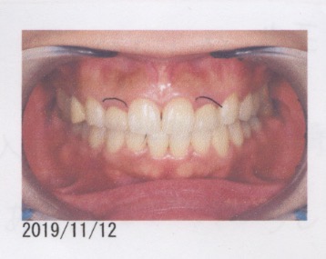 歯肉のラインを揃えたい