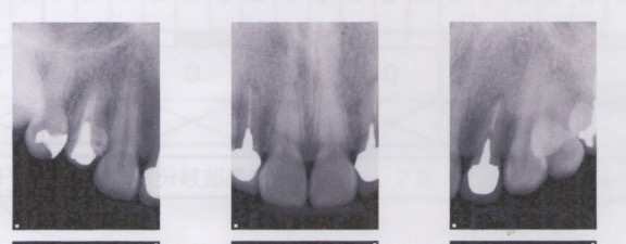 歯肉のラインを揃えたい