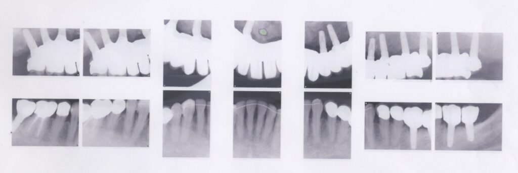 入れ歯からインプラントにしたい５０代女性