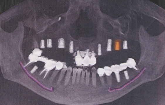 入れ歯からインプラントにしたい５０代女性