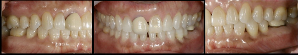 Immediate implant placement after tooth extraction　delayed implant placement