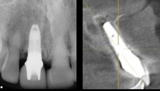 Immediate implant placement after tooth extraction