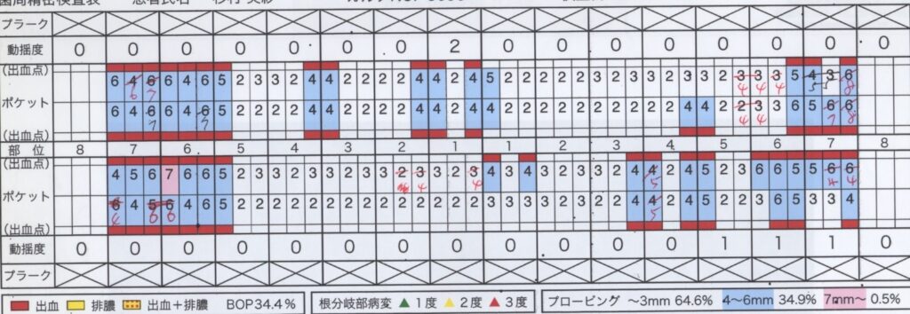 打撲した上の前歯をインプラントに