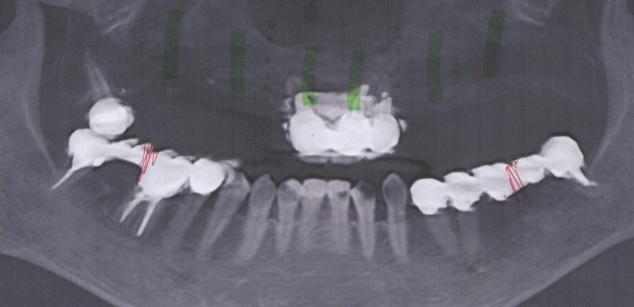 入れ歯からインプラントにしたい５０代女性