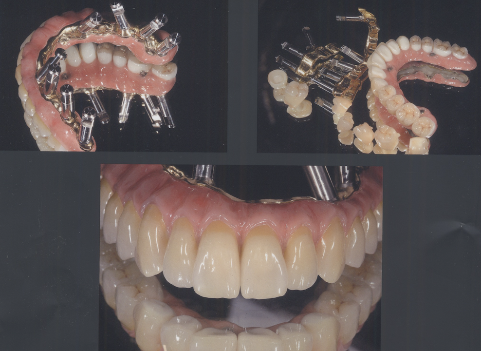 入れ歯からインプラントにしたい５０代女性