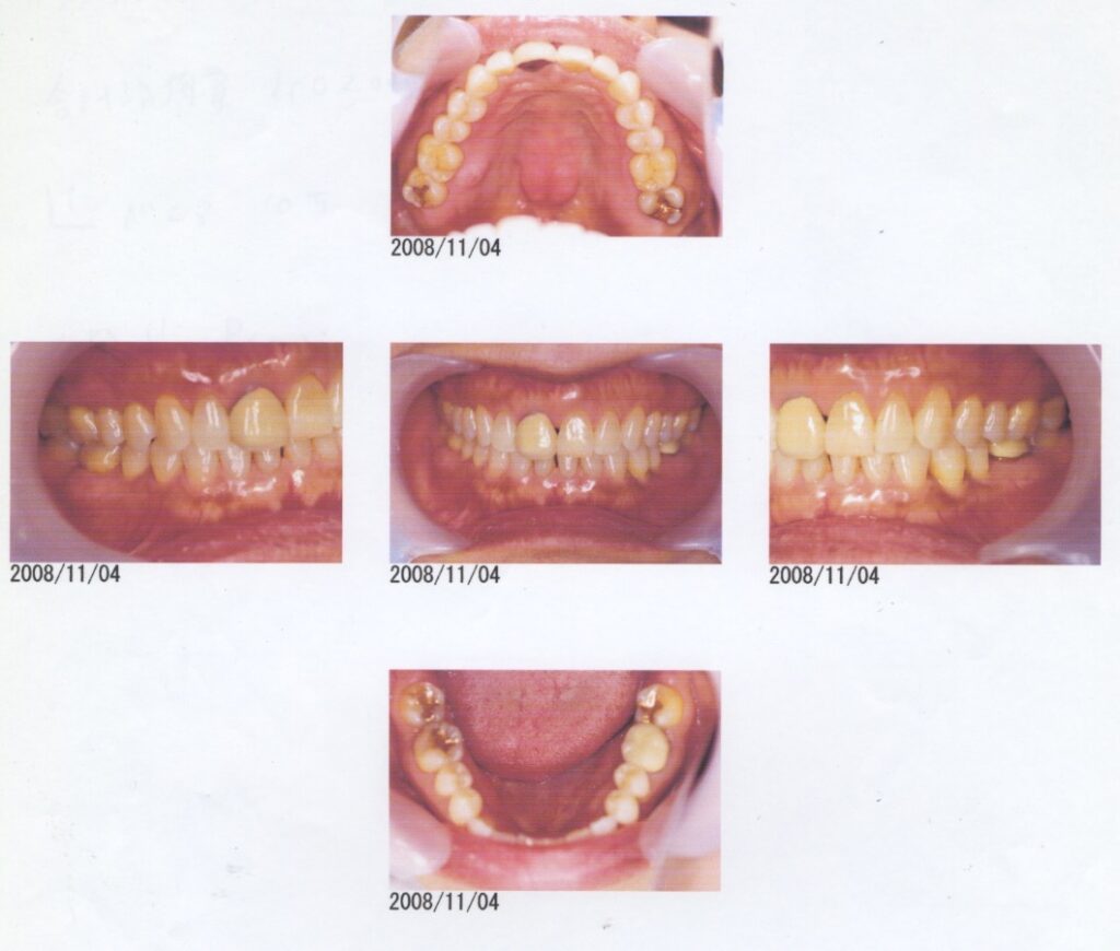 打撲した上の前歯をインプラントに