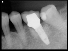 delayed implant placement