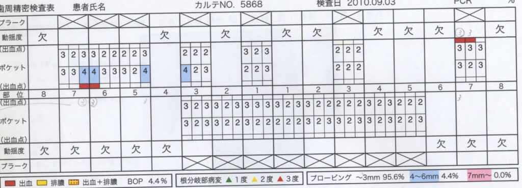 入れ歯をインプラントにしたい４０代男性