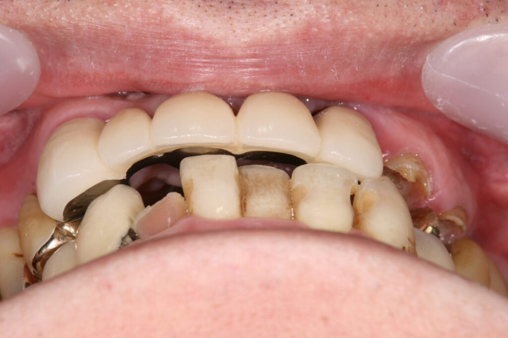 implant