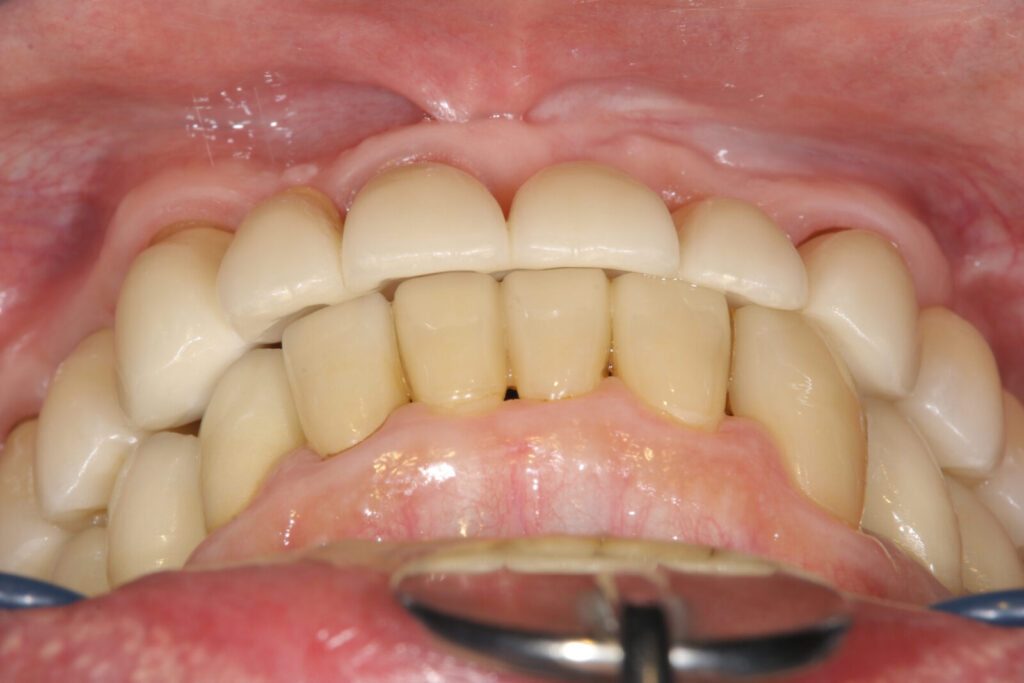implant final