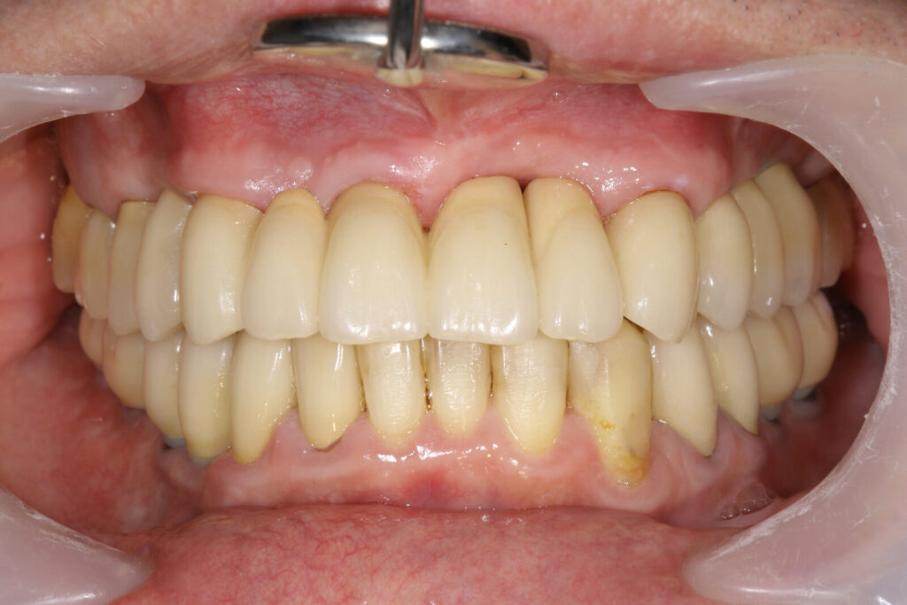 implant post