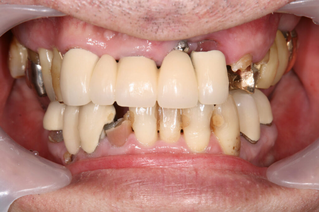 implant pre