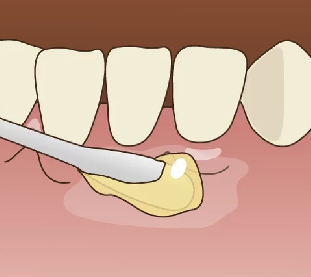 インプラントFAQ