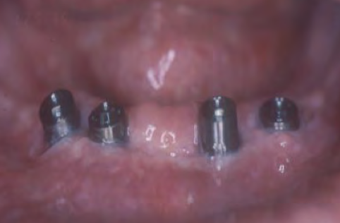 インプラントFAQ