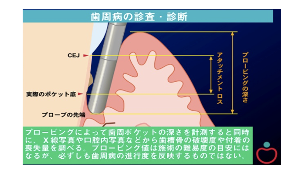 歯周病検査
