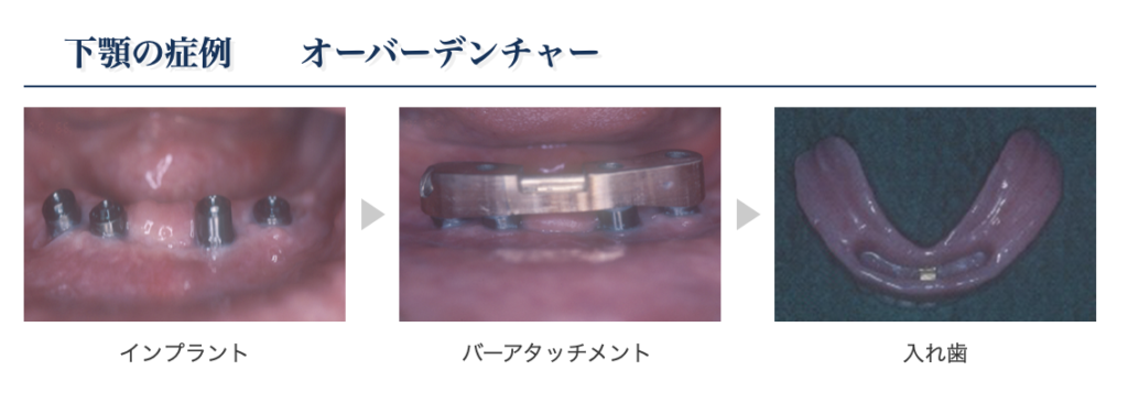 歯１本もない