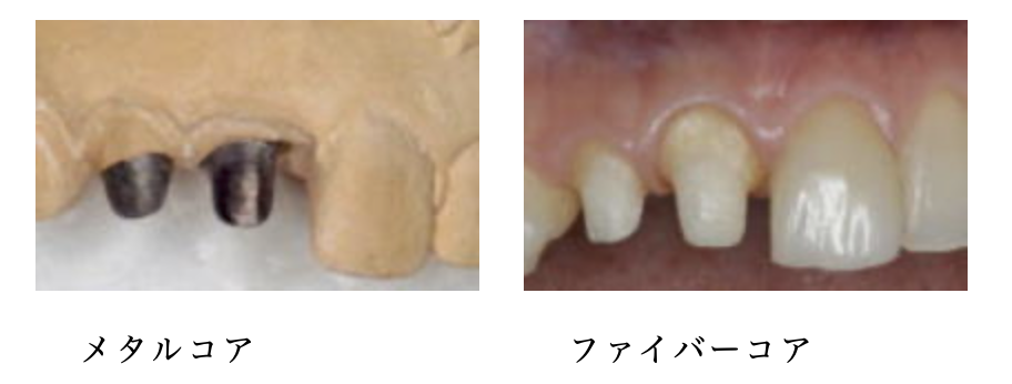 ファイバーポスト