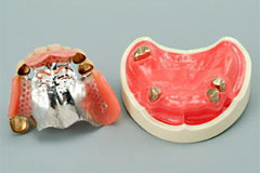 コーヌステレスコープ義歯